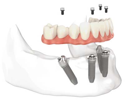 all on Four implant