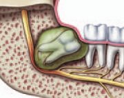 Wisdom teeth