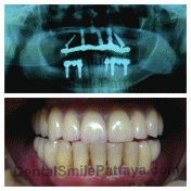 All-on4 implant